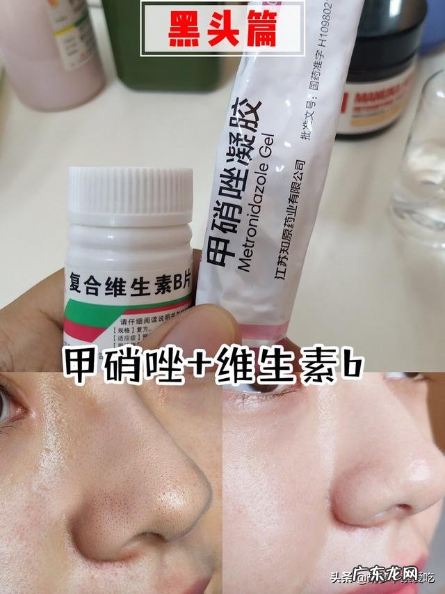 我脸上总长闭口小疙瘩怎么办?要用什么洗脸才能除掉?
