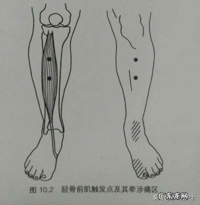 运动后小腿迎面骨疼怎么办 为什么每次运动过后小腿迎风骨都痛呢?