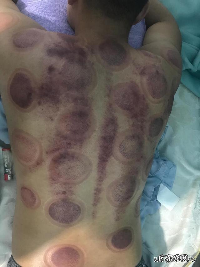 足疗刮痧拔罐有哪些好处?