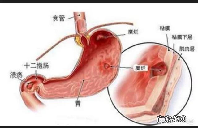 慢性胃炎都有哪些症状在生活中要注意哪些不良习惯