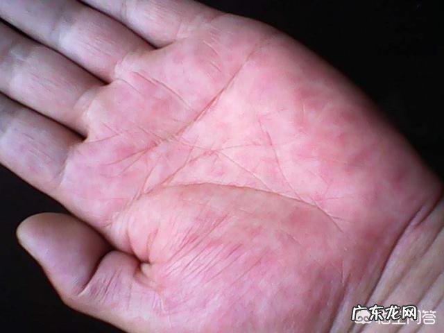 脂肪肝严重吗？有什么症状？怎么预防？ 怎么预防脂肪肝最有效