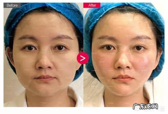 脸比较瘦,两颧骨下面凹陷,有什么办法能让它丰满起来?