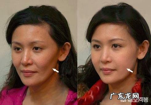 脸比较瘦,两颧骨下面凹陷,有什么办法能让它丰满起来?