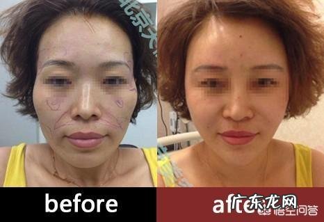 脸比较瘦,两颧骨下面凹陷,有什么办法能让它丰满起来?