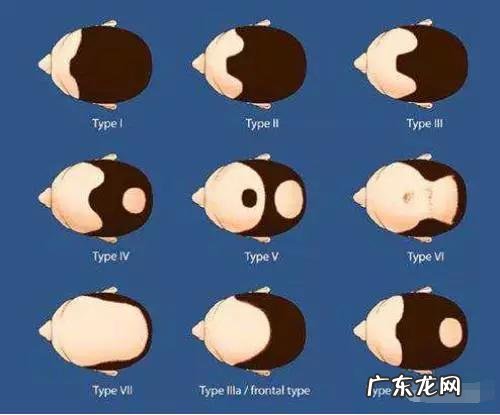 为什么秃顶的大多数都是男性,却从没看过女性秃顶