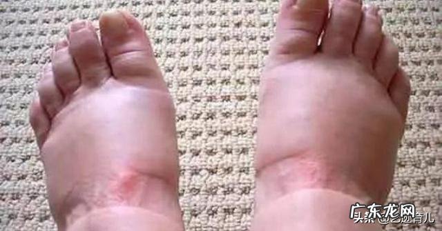 怀孕几个月会水肿?为什么会水肿？