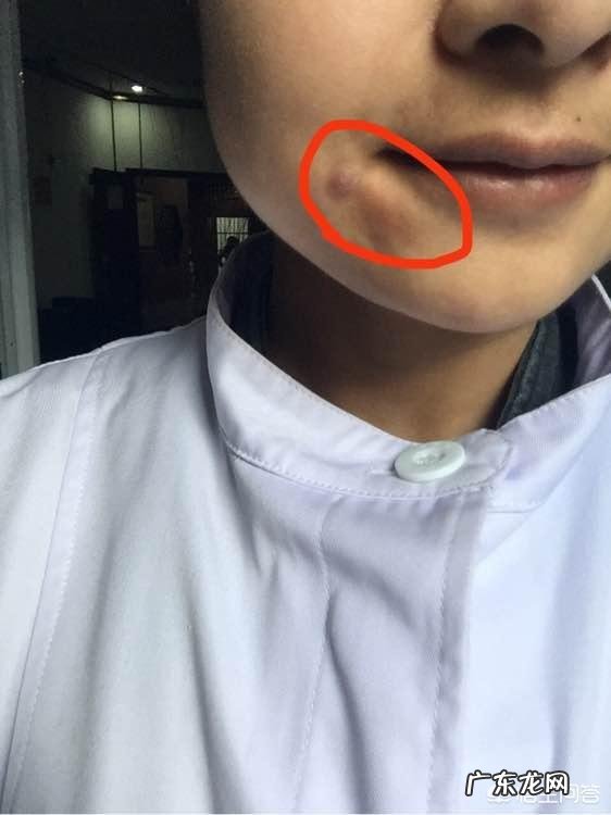 现在流行的线雕美容有近期和远期危害吗？