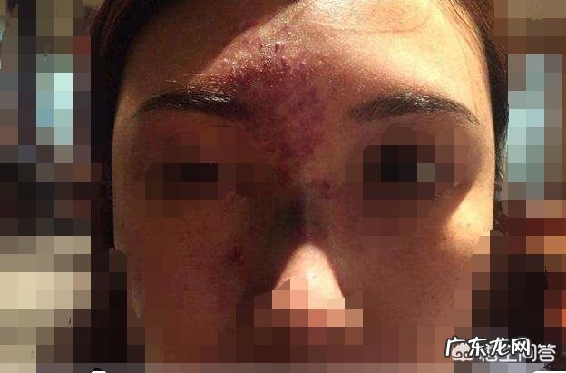 现在流行的线雕美容有近期和远期危害吗？