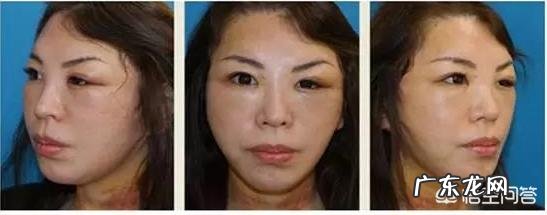 现在流行的线雕美容有近期和远期危害吗？