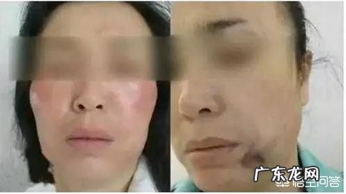 现在流行的线雕美容有近期和远期危害吗？