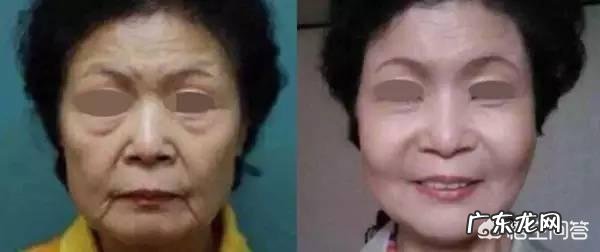 现在流行的线雕美容有近期和远期危害吗？