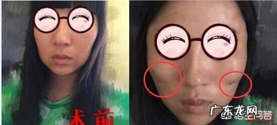 现在流行的线雕美容有近期和远期危害吗？