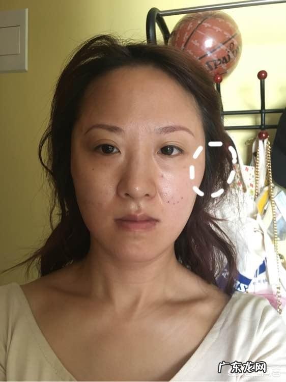 现在流行的线雕美容有近期和远期危害吗？