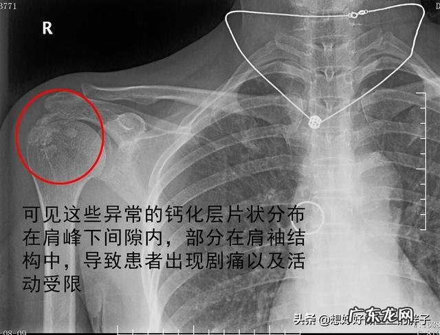 请问肩周炎怎么缓解,疼的半夜睡不着觉,有什么好的方法?