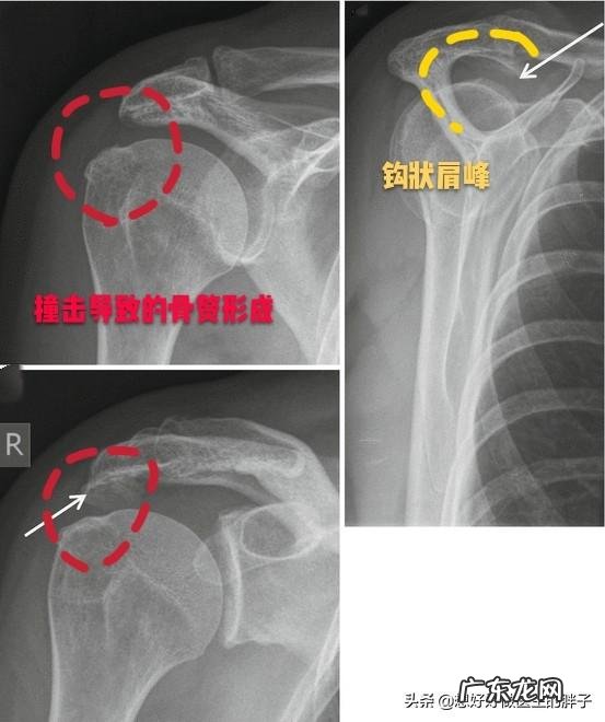 请问肩周炎怎么缓解，疼的半夜睡不着觉，有什么好的方法？