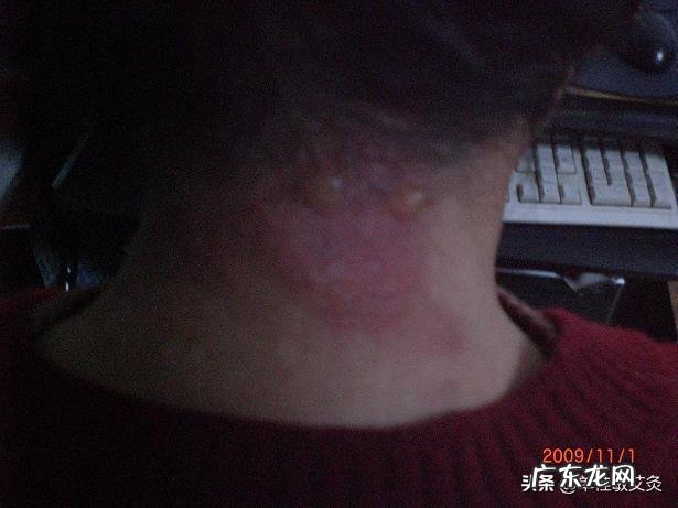 脖子僵硬颈椎痛,还伴有头晕,怎么办?吃什么药能缓解?