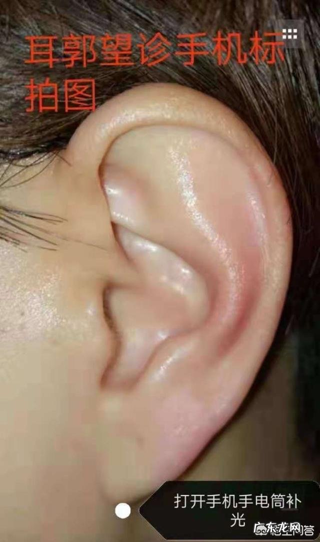 心脏病患者可以吃鱼油吗?有什么不适合吃鱼油的人群吗?