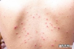 背上反复长痘痘有什么快速有效方法祛除痘痘和痘印吗？
