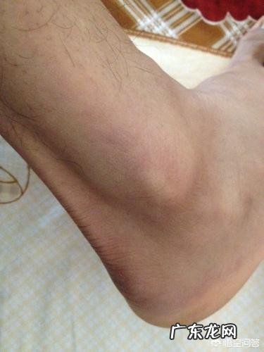 为什么有的人的踝关节容易扭伤