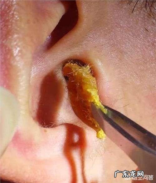 孩子三岁了,耳朵里有耳屎能挖干净吗
