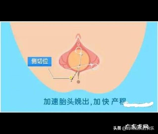 孕妇怎么做才不会被侧切？