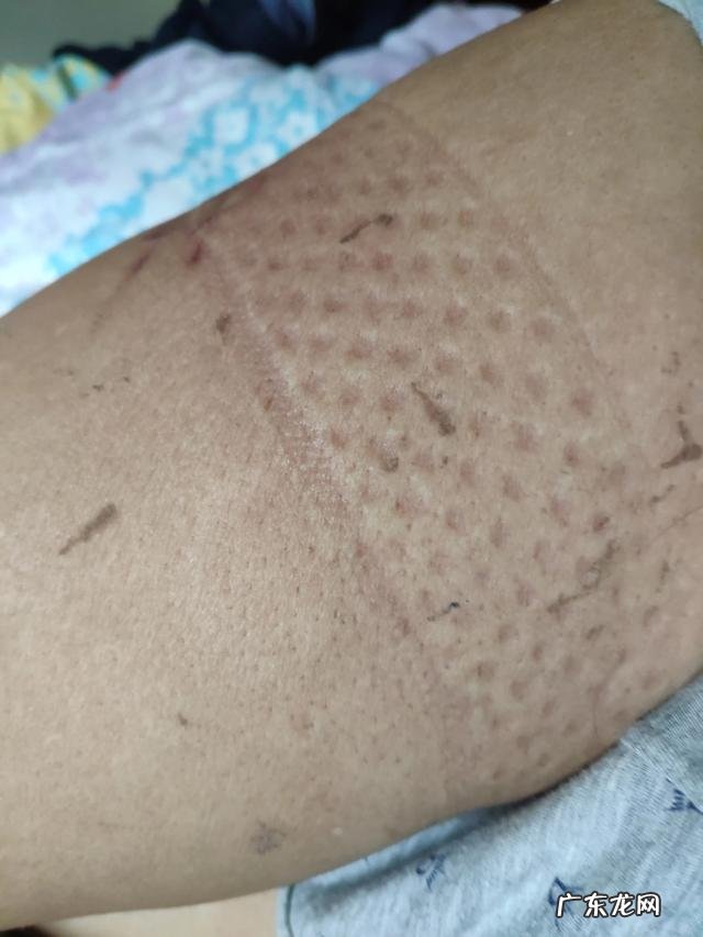 小腿静脉曲张，用医用弹力袜可以预防吗？晚上睡觉可以穿着么？