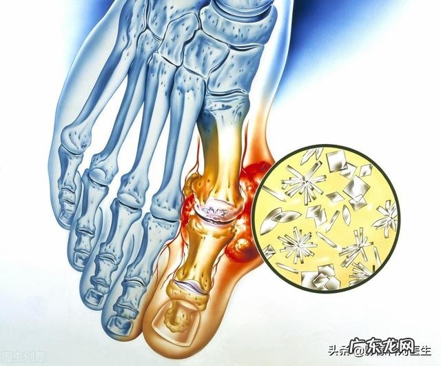 尿酸500多不发作不疼 尿酸500，但是不发作也不痛，需要医zhi吗？
