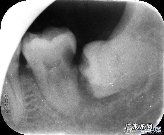 拔掉智齿后,你多久才敢吃东西?