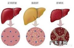 中度脂肪肝怎么办需要怎么吃做哪些运动