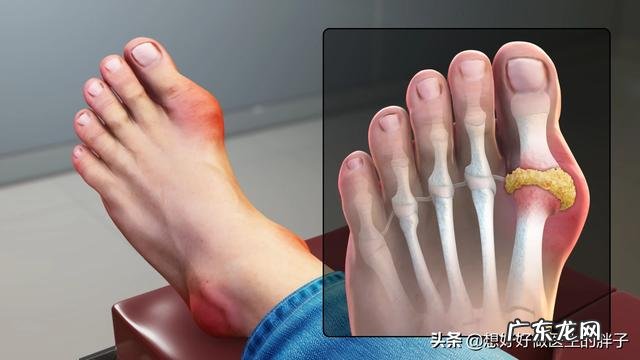 什么样的女性容易得痛风?