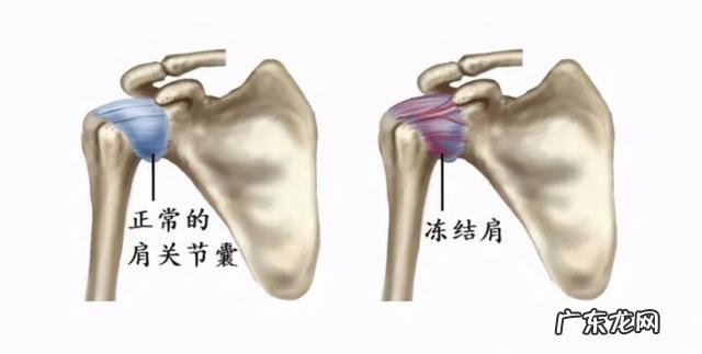 肩周炎太难受了,有好办法吗?
