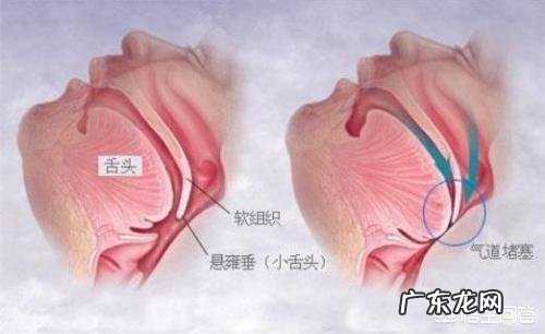 晚上睡觉的时候,有时候会被胃里返上来的酸水呛醒,怎么回事?