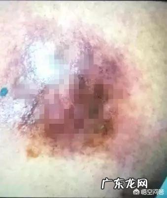 武汉男子自己在家拔火罐,身上的脓包一个变成三个,是怎么回事?