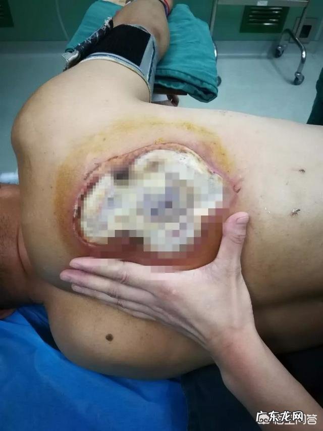 武汉男子自己在家拔火罐,身上的脓包一个变成三个,是怎么回事?