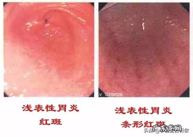 得了慢性胃炎要多久才能zhi好？ 慢性浅表性胃炎中药能zhi好么