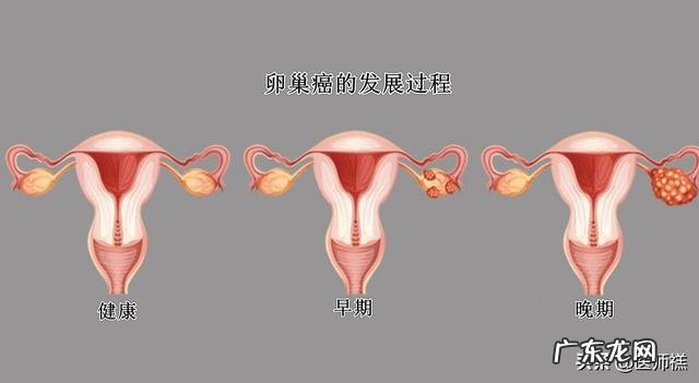 卵巢囊肿切除后复发怎么办?