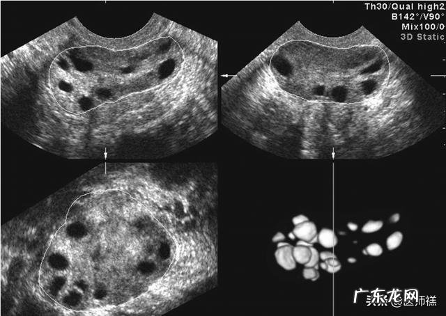 卵巢囊肿切除后复发怎么办?