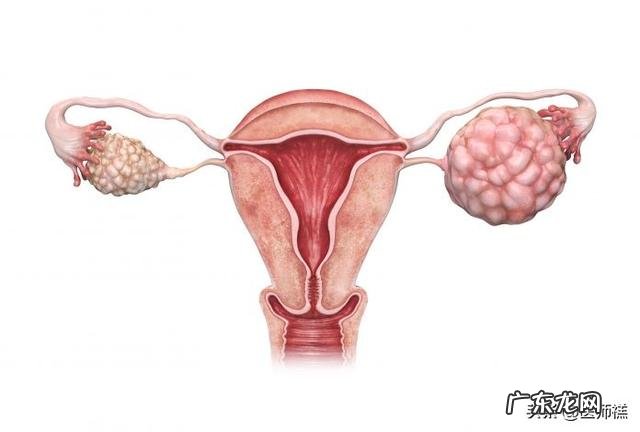 卵巢囊肿切除后复发怎么办?