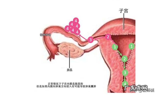 卵巢囊肿切除后复发怎么办?