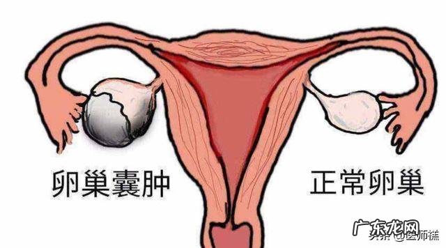 卵巢囊肿切除后复发怎么办?