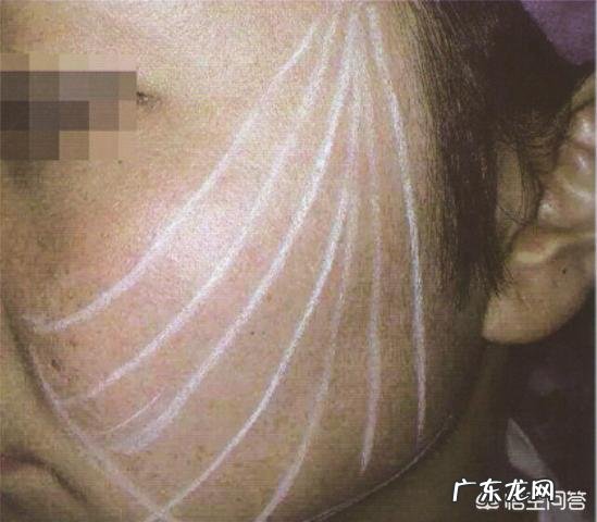 埋线做完表情夸张蛋白线会断掉吗？