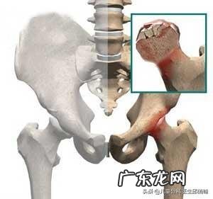 髋关节疼痛是股骨头坏死了吗股骨头坏死有哪些表现