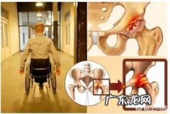 髋关节疼痛是股骨头坏死了吗股骨头坏死有哪些表现