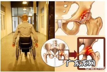 髋关节疼痛是股骨头坏死了吗股骨头坏死有哪些表现