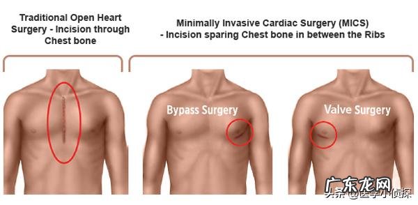 甲状腺手术有哪些后期影响