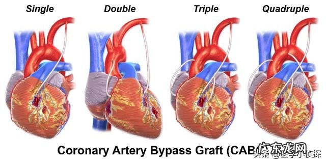 甲状腺手术有哪些后期影响