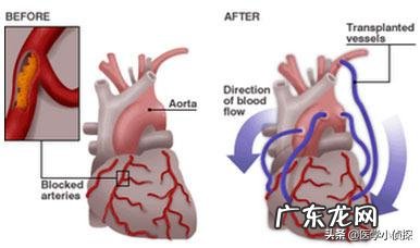 甲状腺手术有哪些后期影响