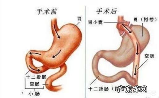 做了甲状腺手术后，身体发胖是为什么该如何zhi疗