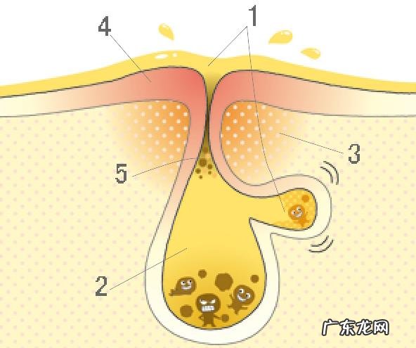最近脸上痘痘泛滥,各路大神有什么解决方法?