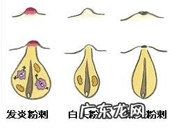 最近脸上痘痘泛滥,各路大神有什么解决方法?